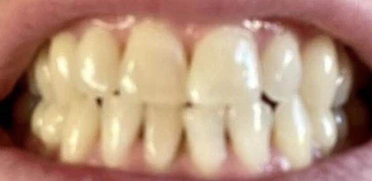 Pure Glow customer Dan's teeth before starting the 14 day PAP whitening strips treatment