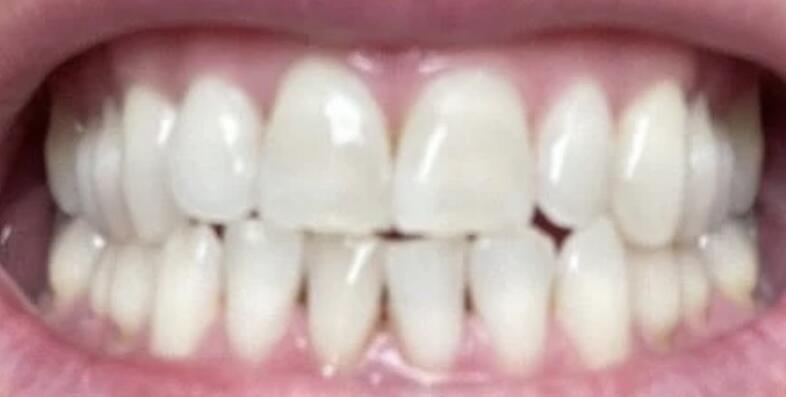 Pure Glow customer Dan's teeth after completing the 14 day PAP whitening strips treatment