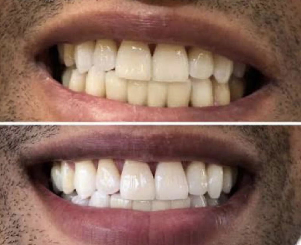 Before and after photo from a verified Pure Glow customer showing teeth before and after using PAP whitening strips, with the before shot above and the after shot below