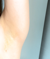 Removely IPL 3+   (inkl. Summer Sale Geschenk)