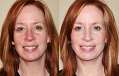 RosaLight™ - The Rosacea Phototherapy Mask