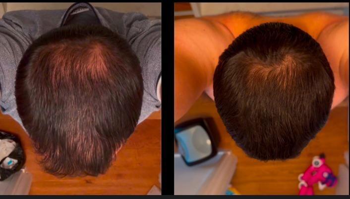 ShinyHair - Follicle Support Complex - for men Kopie
