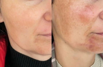 Resultado de antes y después de hiperpigmentación en mandíbula y mentón