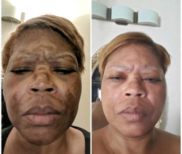 Resultado de antes y después de hiperpigmentación facial extensa