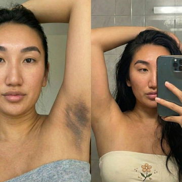 Resultado de antes y después de hiperpigmentación en axilas