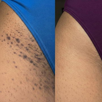 Resultado de antes y después en línea del bikini y entrepierna