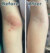 Atopic-Prone Skin Care Oil