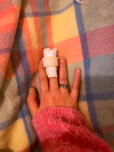 Comminuted Fracture review photo