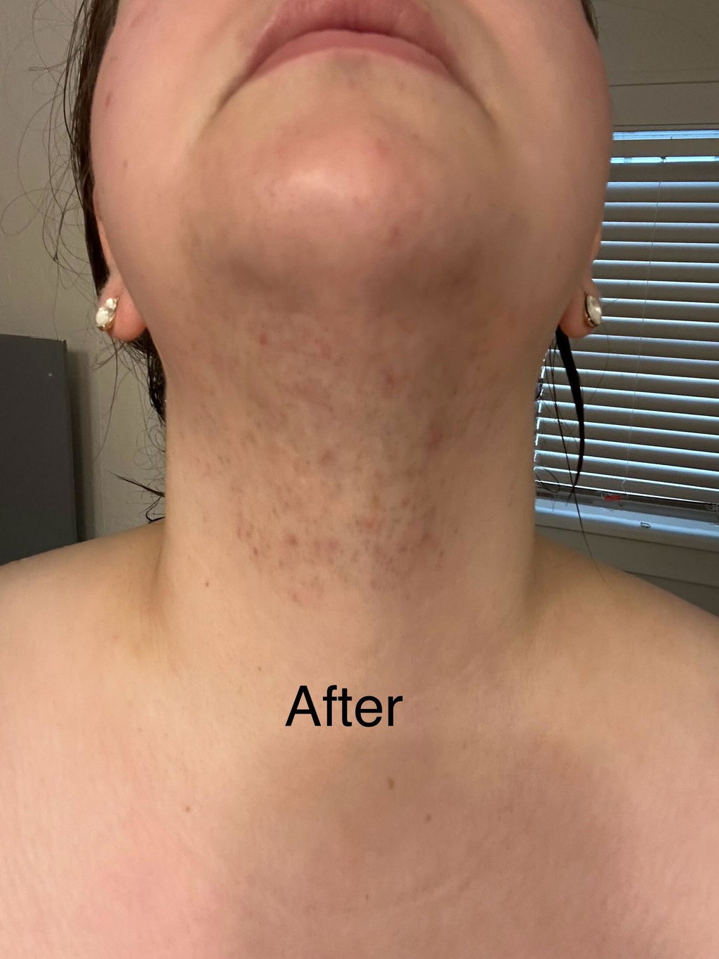 Hair Reducing Fade Oil | For PCOS & Hirsutism-Related Facial Hair
