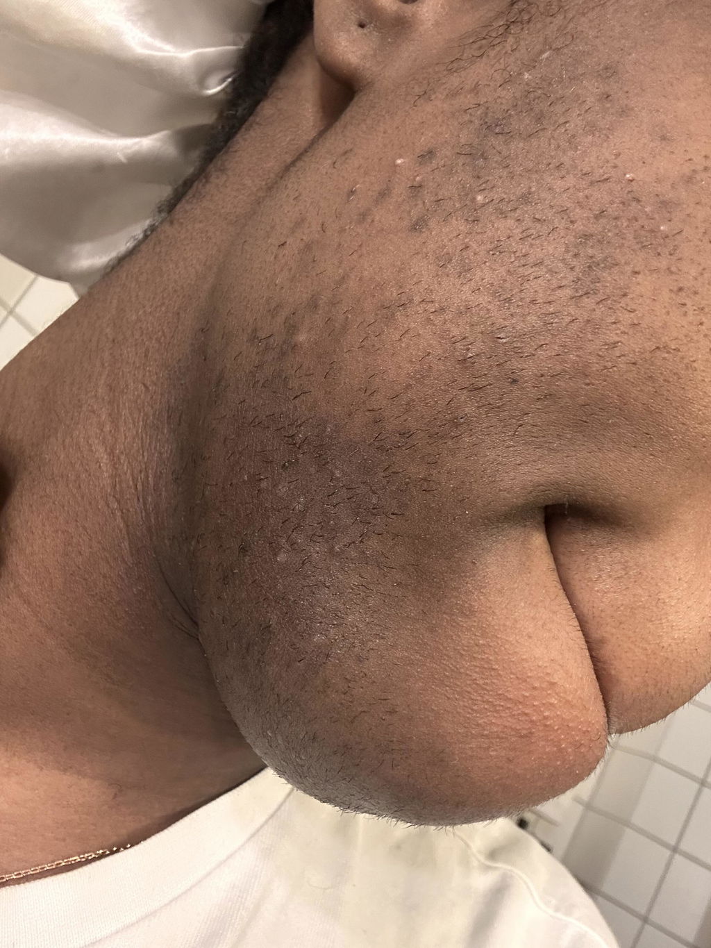 Hair Reducing Fade Oil | For PCOS & Hirsutism-Related Facial Hair