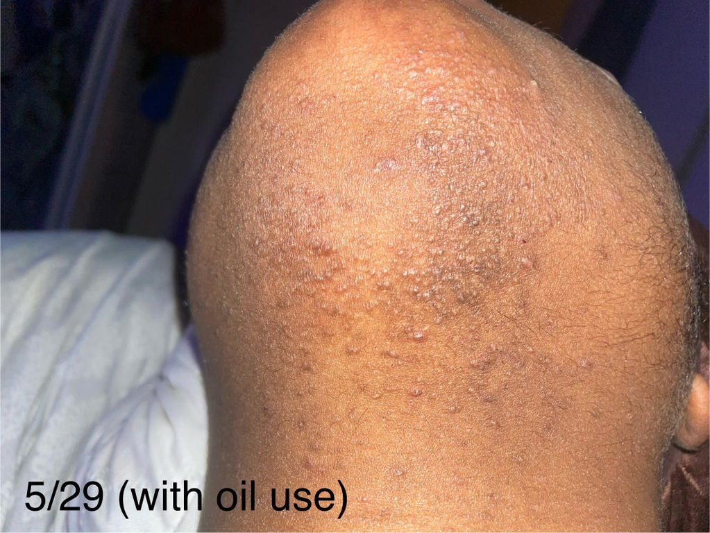 Hair Reducing Fade Oil | For PCOS & Hirsutism-Related Facial Hair