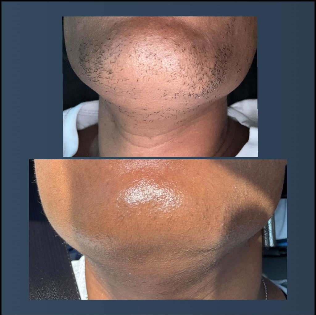 Hair Reducing Fade Oil | For PCOS & Hirsutism-Related Facial Hair