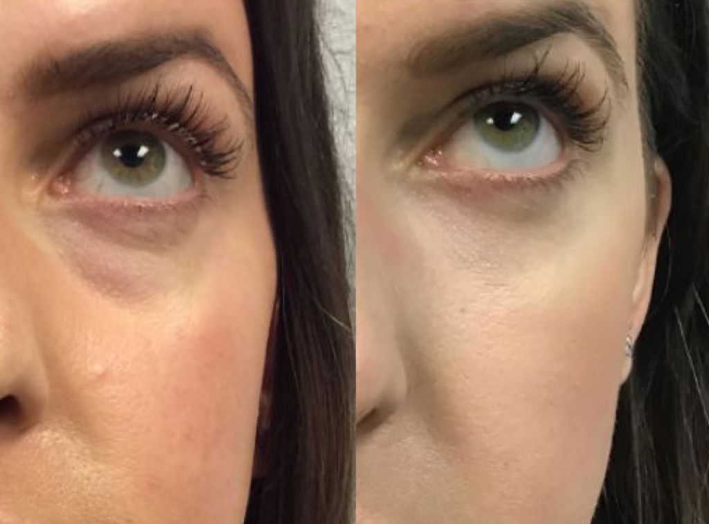 ISA 💕✨ VARITA MAGIC LED FACIAL
