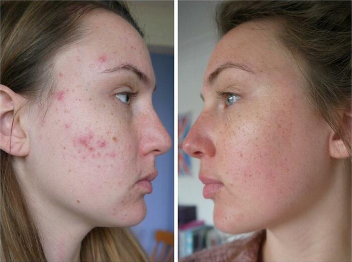 VAIOLET LIMPIADOR FACIAL ULTRASÓNICO MORADO